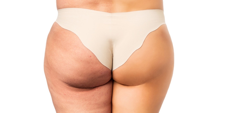 Was hilft gegen Cellulite